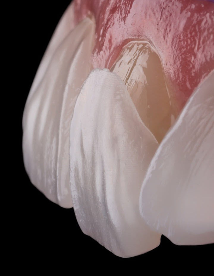 Close-up macro photo of a Neer no-prep veneer